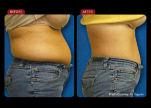 Before and after image of a woman who used Zerona Z6 with noticeable inches lost on her waist. 